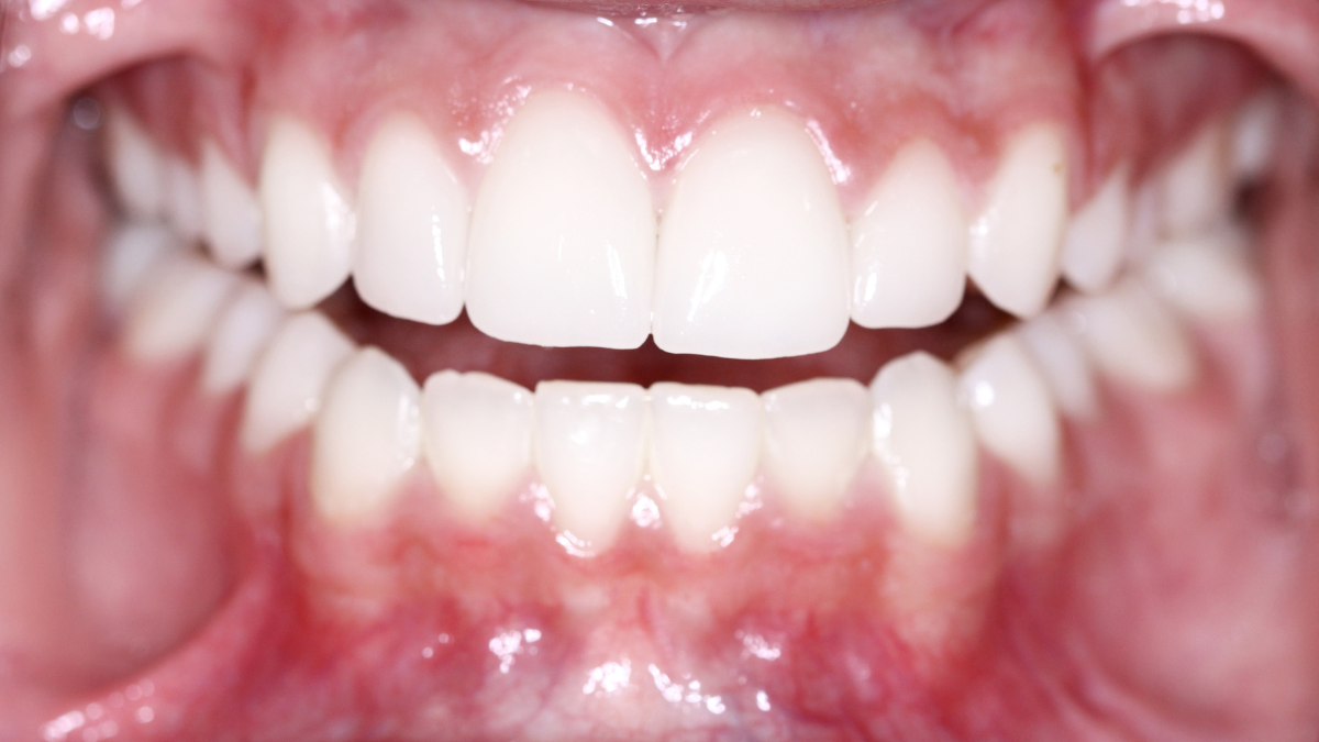 Dientes blancos